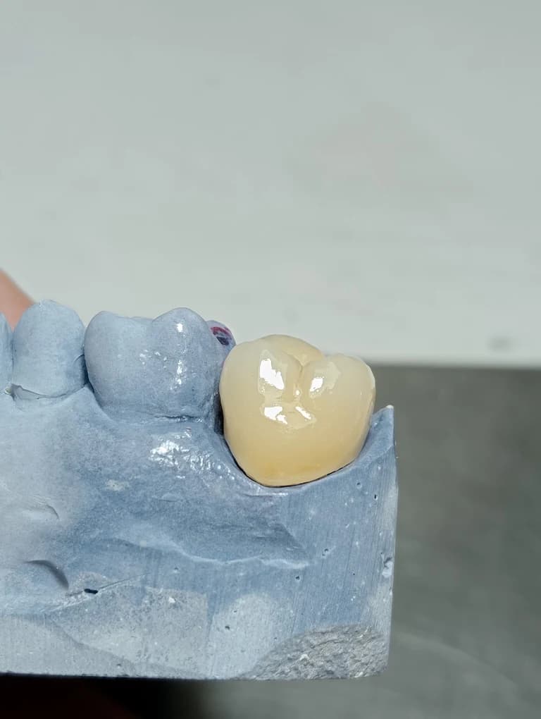 Corona dental unitaria sobre modelo de trabajo, restauración de precisión de Marsadent
