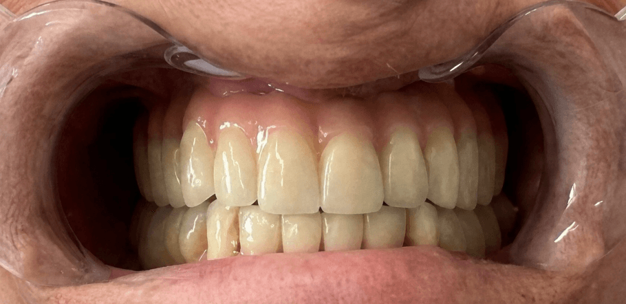 Prótesis dental completa colocada en boca, trabajo real del laboratorio Marsadent