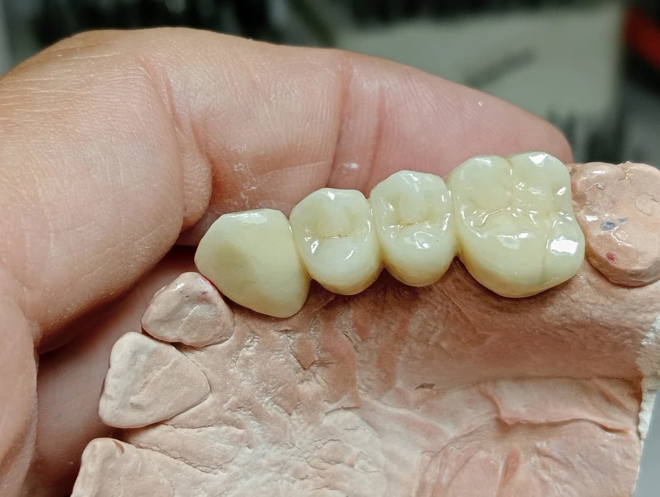 Puente de coronas dentales sobre modelo, restauración fija fabricada por Marsadent